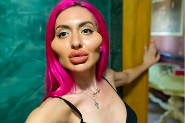 Kỳ quái gò má khủng vì tự tiêm chất làm đầy