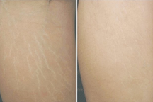 Cách cải thiện rạn da sau sinh lâu năm hiệu quả nhất năm 2019