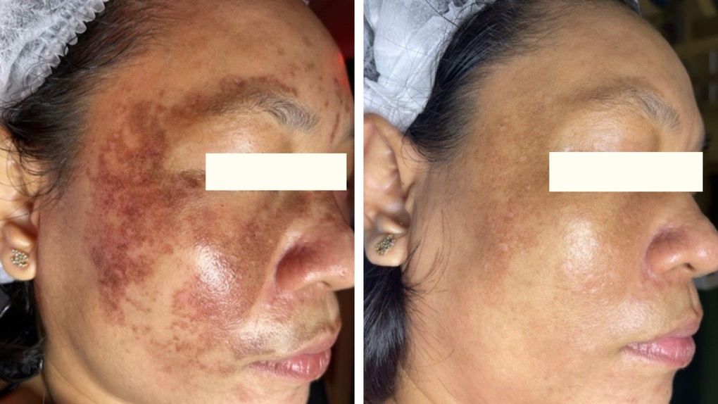 Nguyên nhân gây nám và cách điều trị - 2 Nguyên nhân gây nám và cách điều trị - 2