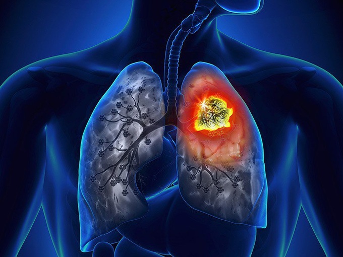 Để phòng ngừa ung thư phổi, cần giảm nguy cơ mắc bệnh bằng việc nói không với thuốc lá, hạn chế tối đa việc hút thuốc thụ động.
