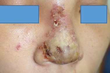 Hà Nội: 5 ngày sau tiêm chất làm đầy, cô gái có ổ mủ trên mũi