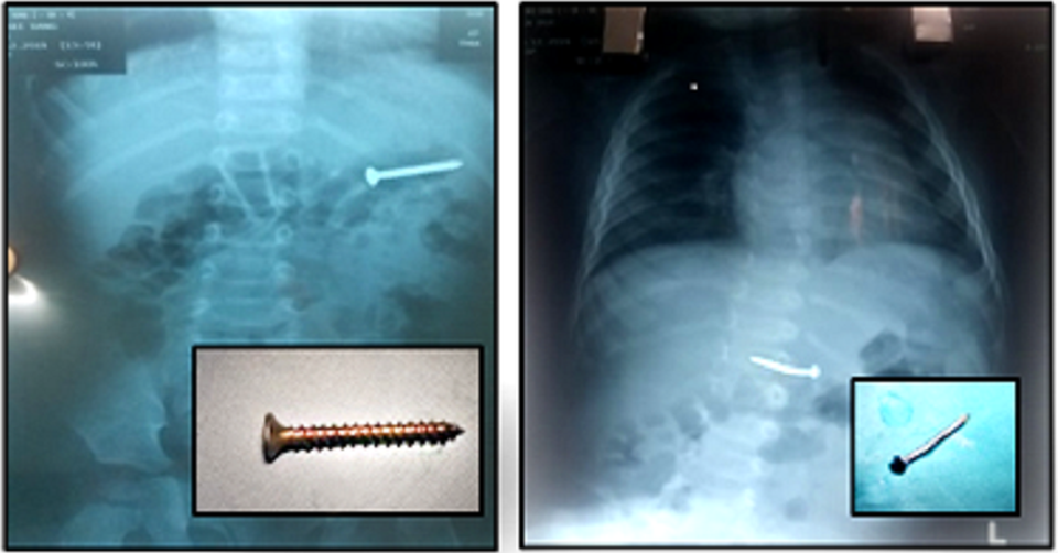 Cha mẹ sơ ý, 2 trẻ nhỏ suýt thủng ruột vì nuốt đinh - 1 Cha mẹ sơ ý, 2 trẻ nhỏ suýt thủng ruột vì nuốt đinh - 1