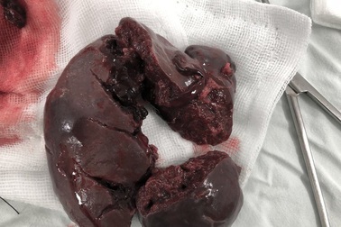 Vỡ lục phủ ngũ tạng sau tai nạn giao thông