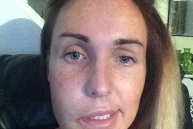 Liệt mặt vì… nhổ răng