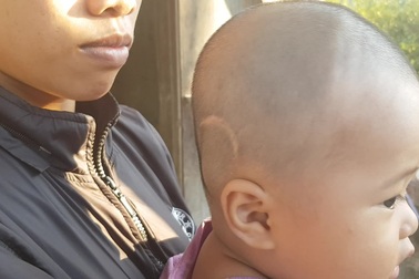 Thương bé trai 10 tháng tuổi bị não úng thủy, uống thuốc hàng tháng để cầm cự