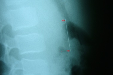 Kim may dài 6cm chui tuột vào dạ dày