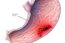 Pepsinogen-giải pháp sàng lọc ung thư dạ dày không xâm lấn
