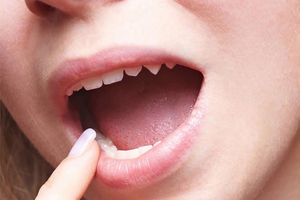 Làm gì để giảm nguy cơ mắc ung thư miệng? - 1 Làm gì để giảm nguy cơ mắc ung thư miệng? - 1
