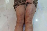 Xác minh nhiều trẻ mầm non bị đánh bầm tím cơ thể