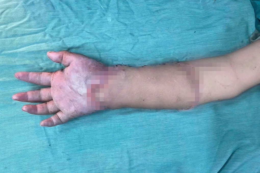 65 ngày làm nên phép màu cho thai phụ phải ghép tạm tay đứt lìa vào chân - 3 65 ngày làm nên phép màu cho thai phụ phải ghép tạm tay đứt lìa vào chân - 3