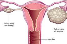 Nhiều trẻ mới hơn 10 tuổi đã bị ung thư buồng trứng