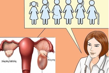 U nang buồng trứng thường gặp ở độ tuổi nào?