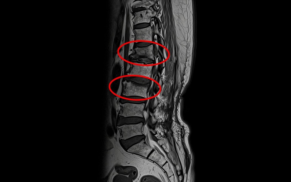 Xẹp cùng lúc 2 đốt sống vì uống thuốc đông y giảm đau xương khớp - 2