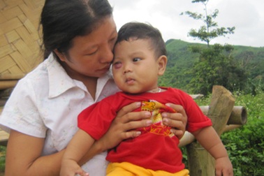 Hành trình đẫm nước mắt của bé 7 tháng tuổi bị u máu