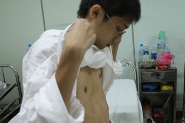 Bệnh nhân phẫu thuật bệnh lõm ngực bẩm sinh tăng đột biến dịp hè