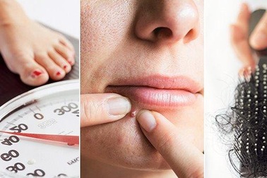 8 dấu hiệu buồng trứng đa nang điển hình, phụ nữ nhất định không được bỏ qua