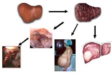 80% bệnh nhân viêm gan vi rút là nhóm B