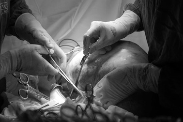 Cô gái trẻ mang khối u ung thư buồng trứng khổng lồ