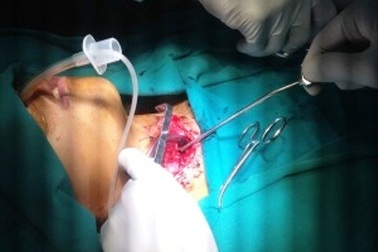 Va chạm giao thông, bé 12 tuổi bị miếng tôn cứa đứt khí quản