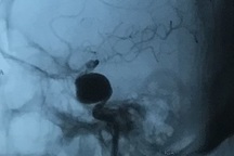 Đau đầu kéo dài, coi chừng phình mạch máu não