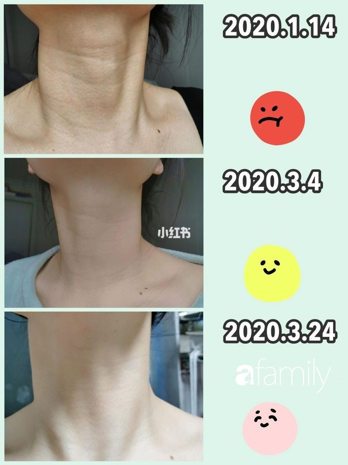Vùng da cổ nhăn nheo của cô nàng này đã thay đổi hoàn toàn chỉ nhờ cách làm đơn giản vô cùng - Ảnh 1. Vùng da cổ nhăn nheo của cô nàng này đã thay đổi hoàn toàn chỉ nhờ cách làm đơn giản vô cùng - Ảnh 1.