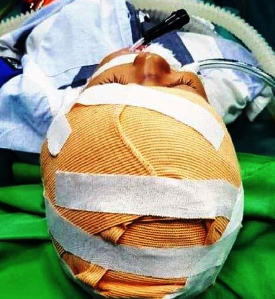 Cháu bé 5 tuổi bị chó nhà cắn rách da đầu - 1 Cháu bé 5 tuổi bị chó nhà cắn rách da đầu - 1