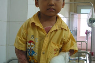 Phẫu thuật tay cho bé Nguyên bỏng vôi toàn thân