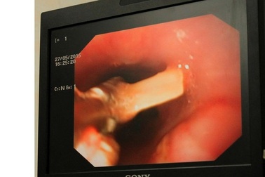 Xương gà chắn ngang thực quản nữ bệnh nhân, đe dọa tính mạng