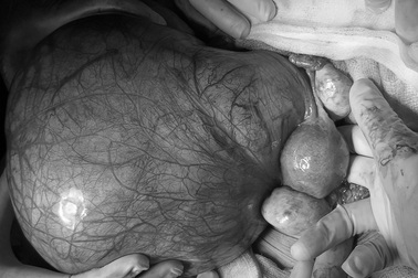 Sau chích nội tiết tố chuyển giới, nữ bệnh nhân thấy bụng lớn dần