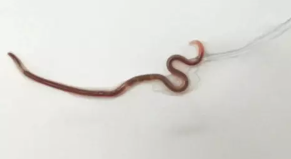 Rùng mình bác sĩ gắp giun 3,8 cm ra khỏi miệng người phụ nữ ăn cá sống - 1 Rùng mình bác sĩ gắp giun 3,8 cm ra khỏi miệng người phụ nữ ăn cá sống - 1