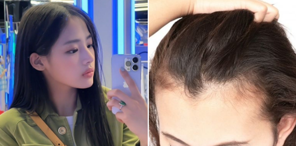 Cắt da đầu, đục lỗ chân tóc để xinh đẹp giống thần tượng Hàn Quốc - 1 Cắt da đầu, đục lỗ chân tóc để xinh đẹp giống thần tượng Hàn Quốc - 1