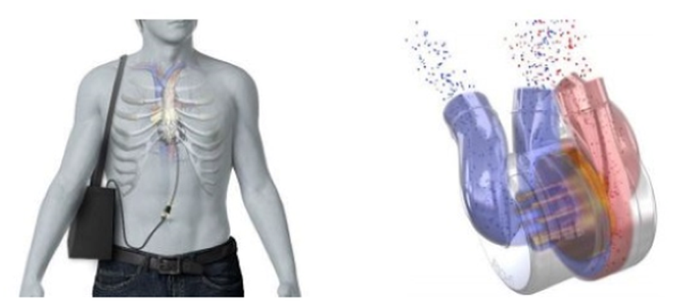 Sắp có tim nhân tạo toàn phần đầu tiên trên thế giới - 1 Sắp có tim nhân tạo toàn phần đầu tiên trên thế giới - 1