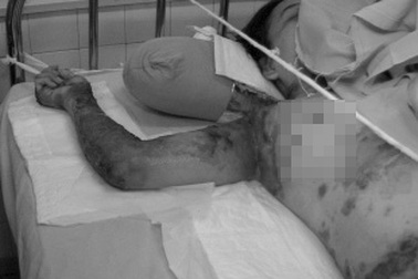 Một bệnh nhân bị tuột da nghiêm trọng