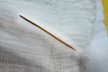 Nuốt phải tăm tre dài 6 cm vào bụng trong lúc ngủ quên