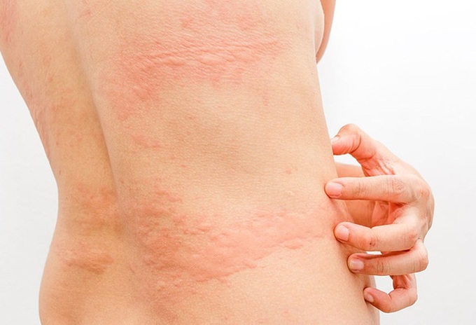 Bị nổi mề đay khắp người khi mang thai ngứa khủng khiếp, hot mom Hằng Túi chỉ dùng cách này mà khỏi ngay tức thì - Ảnh 6. Bị nổi mề đay khắp người khi mang thai ngứa khủng khiếp, hot mom Hằng Túi chỉ dùng cách này mà khỏi ngay tức thì - Ảnh 6.