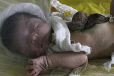 Em bé có tim, gan nằm ngoài bụng