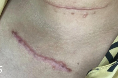 Chi 44 triệu đồng làm đẹp, cô gái được thẩm mỹ viện tặng "con rết" trên cổ