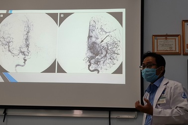 Bé 5 tuổi nhiều lần đột quỵ vì "làn khói" trong não