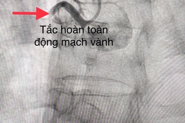 Cảnh báo cơn đau ngực có thể giết chết bệnh nhân nhanh chóng