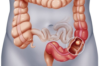 Ung thư và polyp khác nhau như thế nào?
