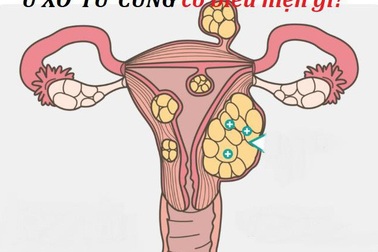 Dấu hiệu nhận biết sớm u xơ tử cung