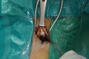 Bệnh nhi sốt run cầm cập suốt 10 ngày, bác sĩ lấy khối mủ lớn nằm trong màng cứng tủy