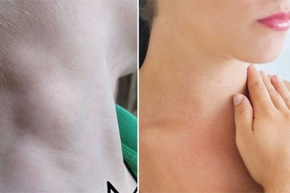 Có một trong những tác nhân này, bạn cần đề phòng ung thư hạch - 1 Có một trong những tác nhân này, bạn cần đề phòng ung thư hạch - 1