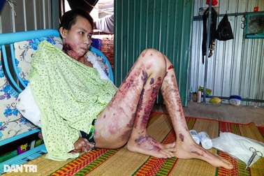 Lời cầu khẩn xin được ghép da của thiếu nữ Hậu Giang bị bạn trai thiêu sống