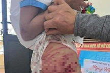 Vụ bé gái lớp 5 nghi bị bạo hành: Công an triệu tập cha dượng