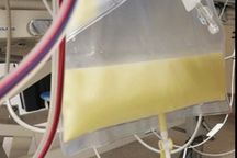 Uống cả lít rượu, người đàn ông có máu đục như sữa