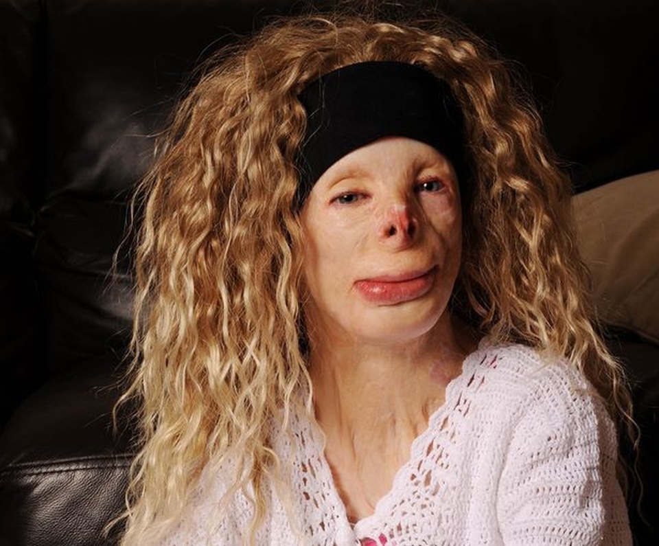 Hạnh phúc bất ngờ của cô gái từng bị bỏng đến biến dạng - 5