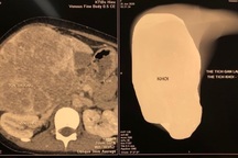 Trẻ mới 12 tuổi đã mắc ung thư gan, cha mẹ cần cảnh giác