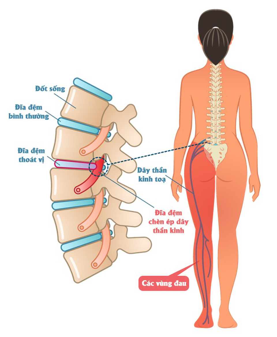 Phương pháp Chiropractic điều trị đau cơ xương khớp - 3