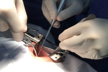 Sau 3 năm, khối u trong khoang miệng hóa ung thư ăn mòn xương